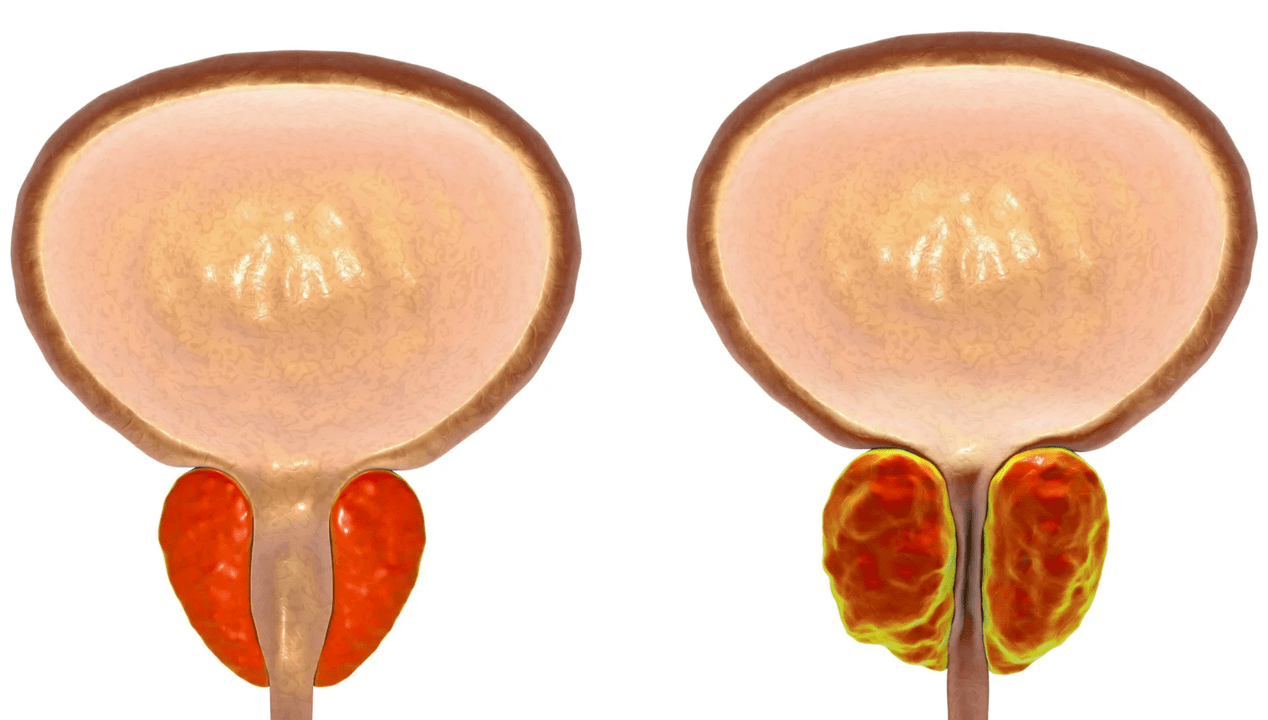 Какво е простатит