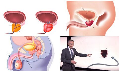 здрава и болна простата